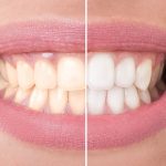 Teeth Whitening